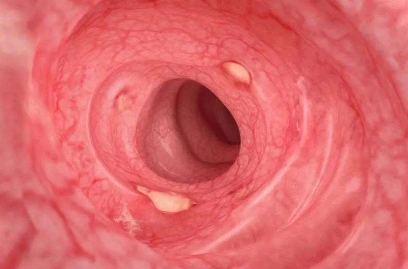 Stage Mild intestine
