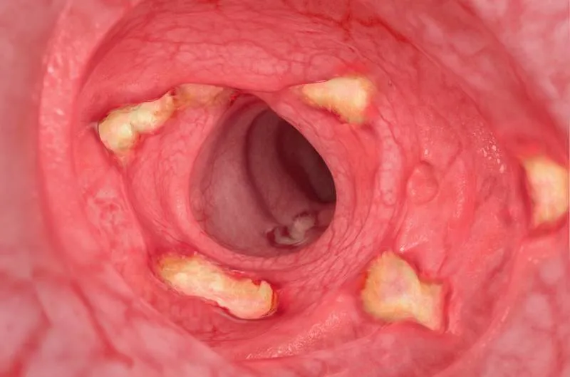 Stage Moderate-severe intestine