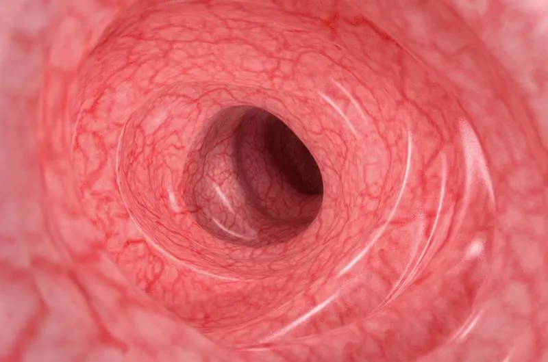 Stage Remission intestine